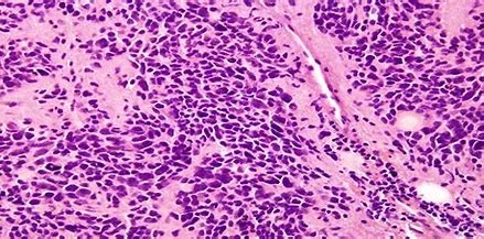 Neuroblastoma